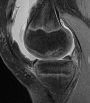 Knee OCD MRI Partially Detached